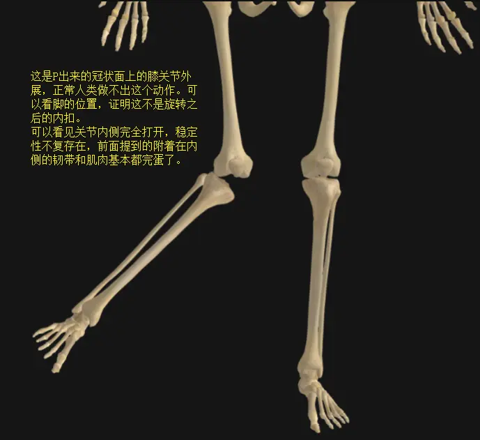 P出来的右侧“膝关节外展”