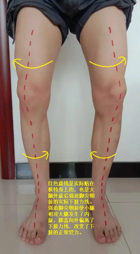 O型腿的下肢力线
