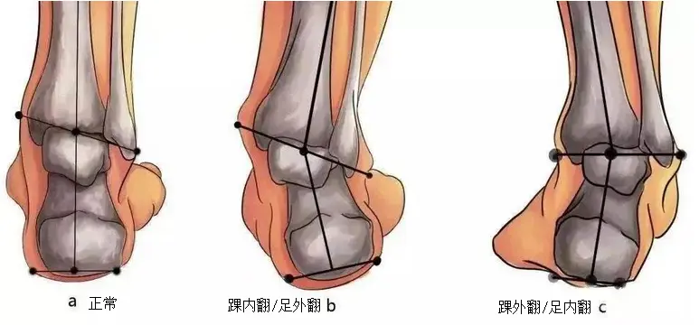 足的后侧力线